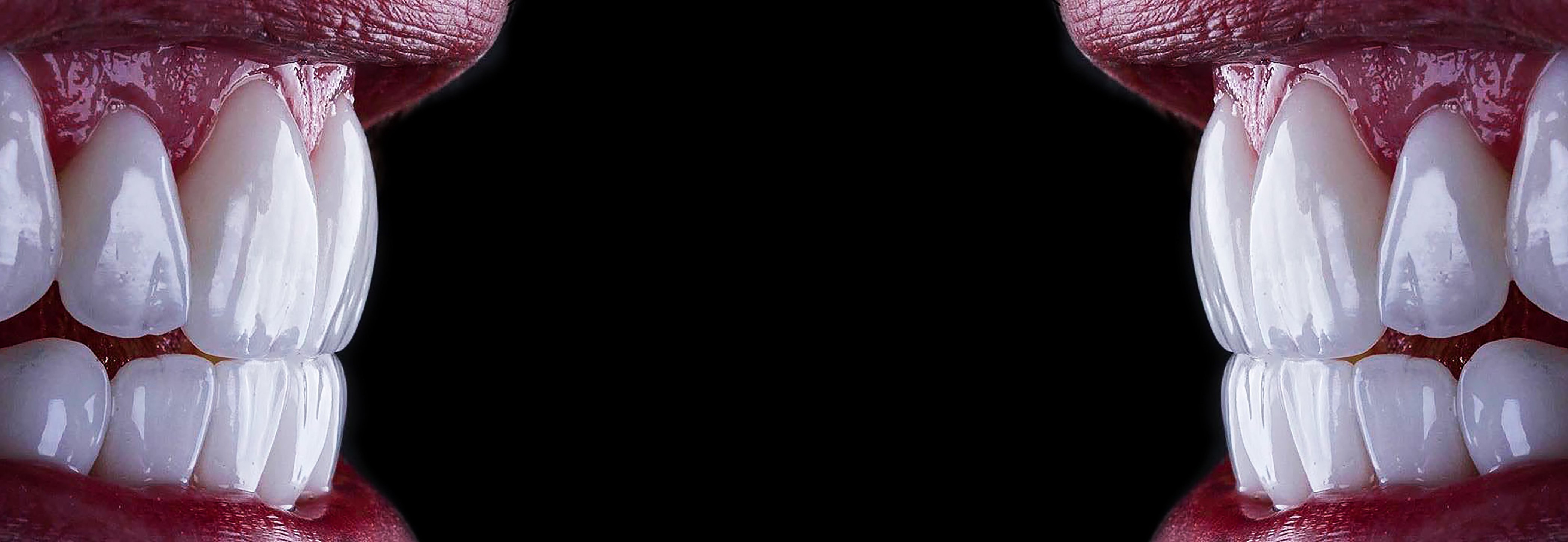 full mought emax press ceramic veneers