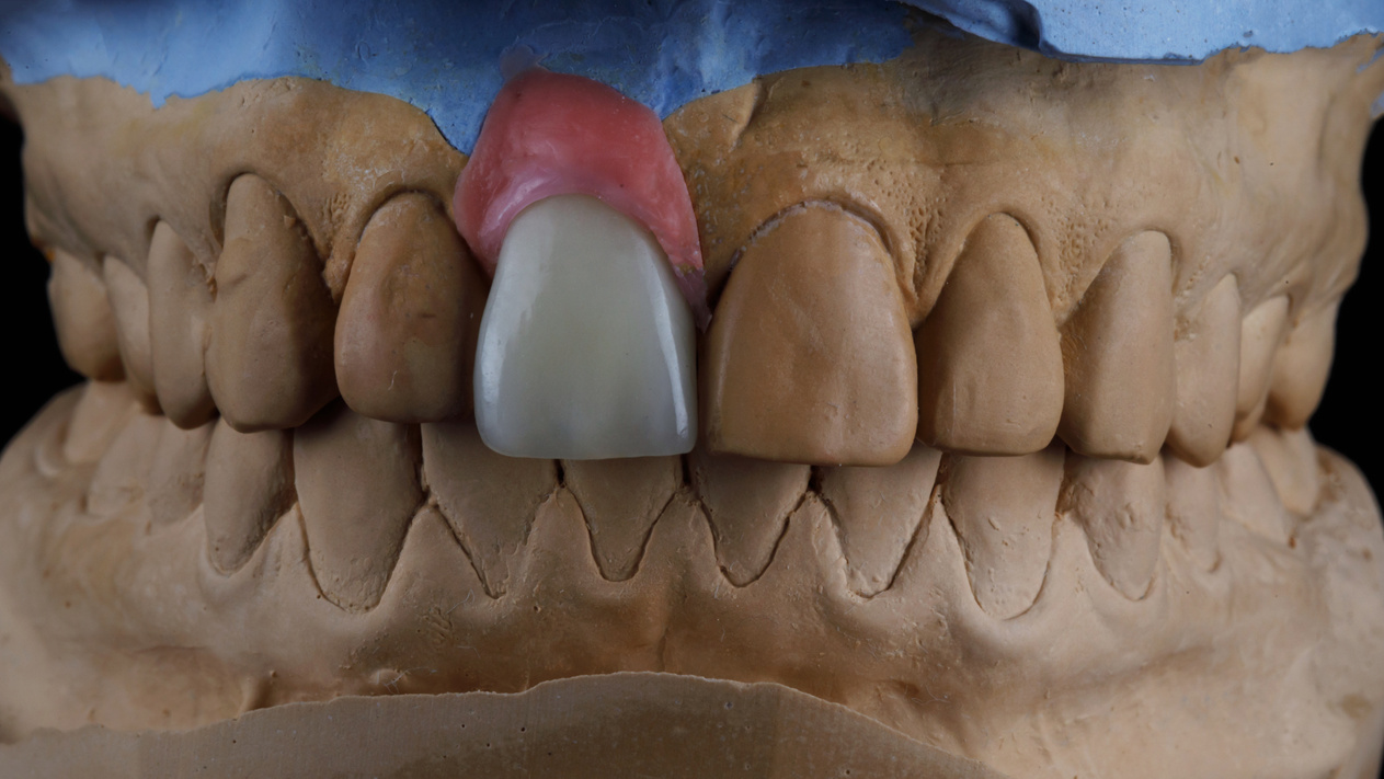 Beautiful Composition of Dental Crown Made of Zircon on a Plaste