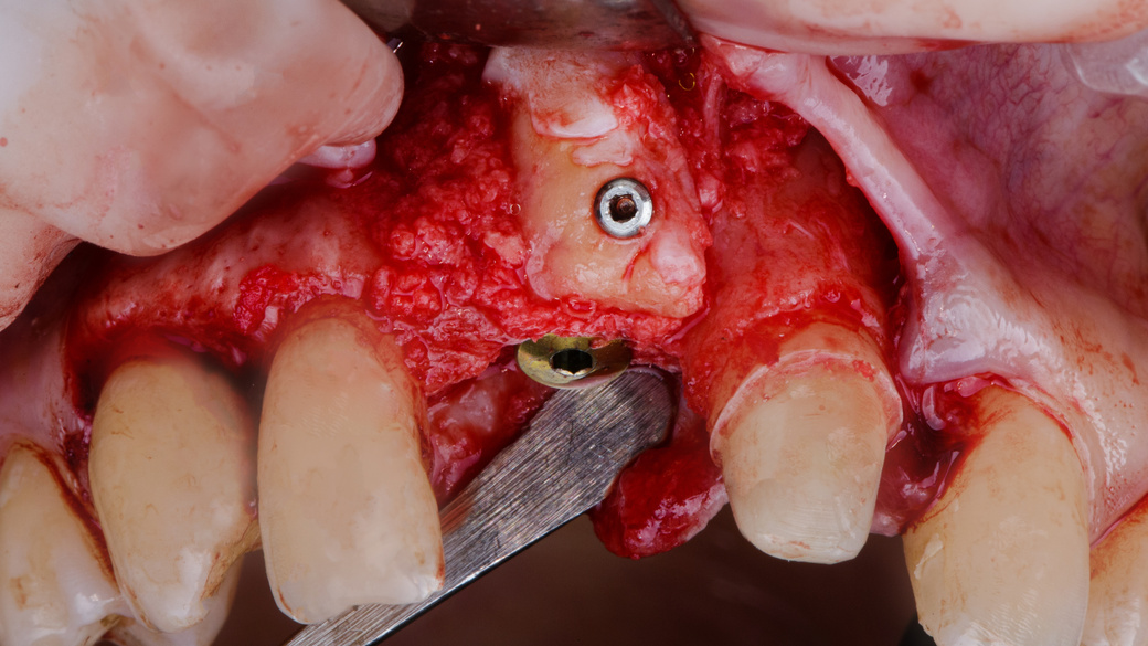 macro photo of dental bone grafting on the after implantat